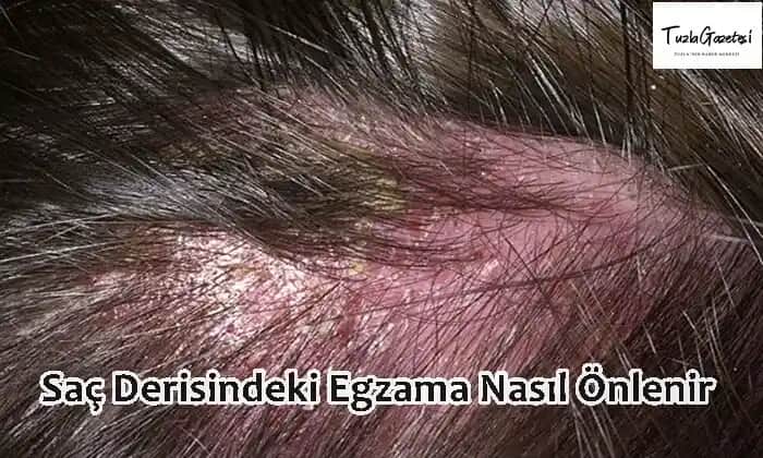 Saç Derisinde Egzama: Belirtileri, Tedavi Yöntemleri ve Bakım İpuçları