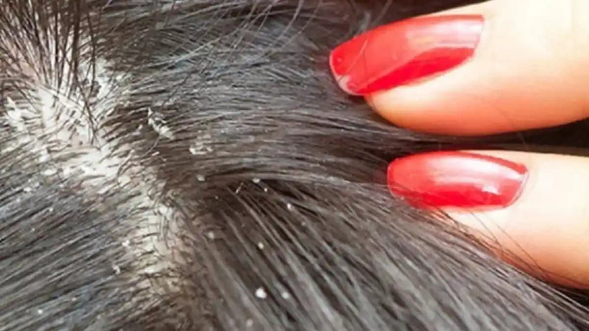 Saç Derisinde Egzama Nedenleri, Belirtileri ve Tedavi Yöntemleri