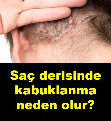 Saç Derisinde Kabuklanma Nedenleri ve Doğru Kozmetik Çözümler