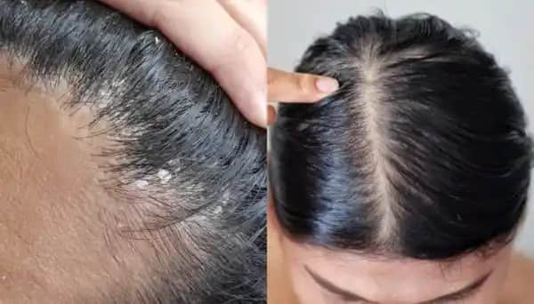 Saç Derisinde Kabuklanma Nedenleri ve Etkili Çözüm Yöntemleri Hakkında Kapsamlı Bilgi