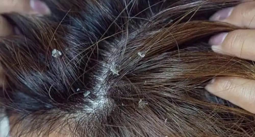 Saç Derisinde Kabuklu Kepek Nedenleri ve Etkili Çözüm Yolları