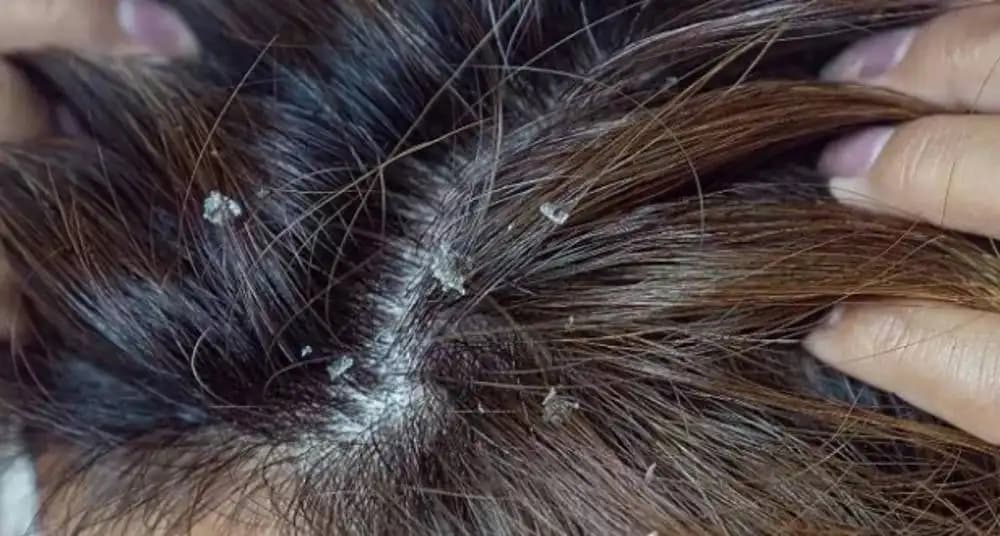 Saç Derisinde Kabuklu Kepek Nedenleri ve Etkili Çözüm Yolları