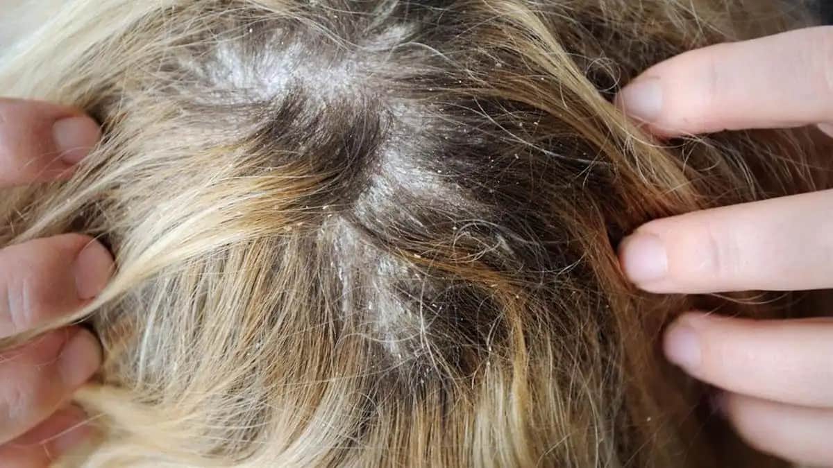 Saç Derisinde Kaşıntı ve Kepek Problemleri: Nedenleri, Çözümleri ve Korunma Yolları