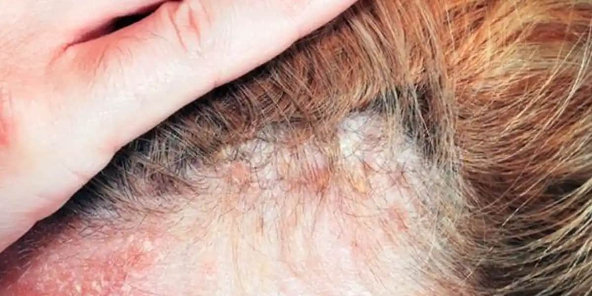 Saç Derisinde Kaşıntı ve Yara Nedenleri, Belirtileri ve Etkili Tedavi Yöntemleri