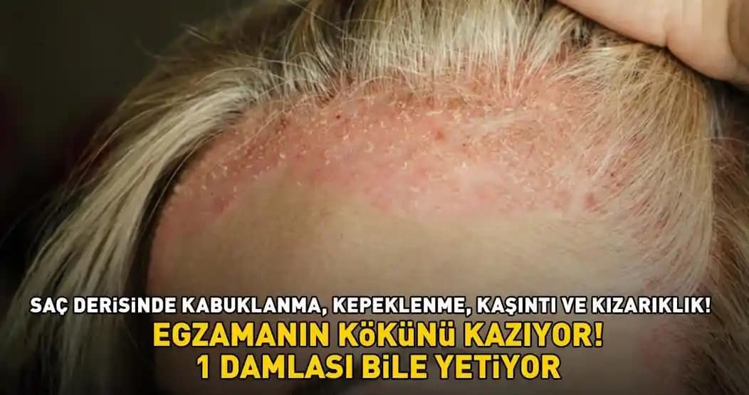 Saç Derisinde Kuruluk ve Kaşıntı Sorunlarına Yönelik Etkili Çözüm Yöntemleri ve Bakım İpuçları