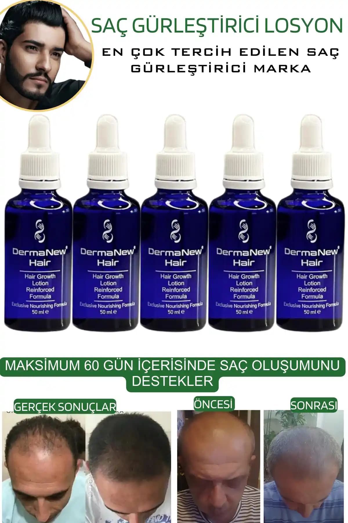 Saç Derisinde Pullanma ve Doğal Çözüm Yöntemleri Hakkında Kapsamlı Bilgi