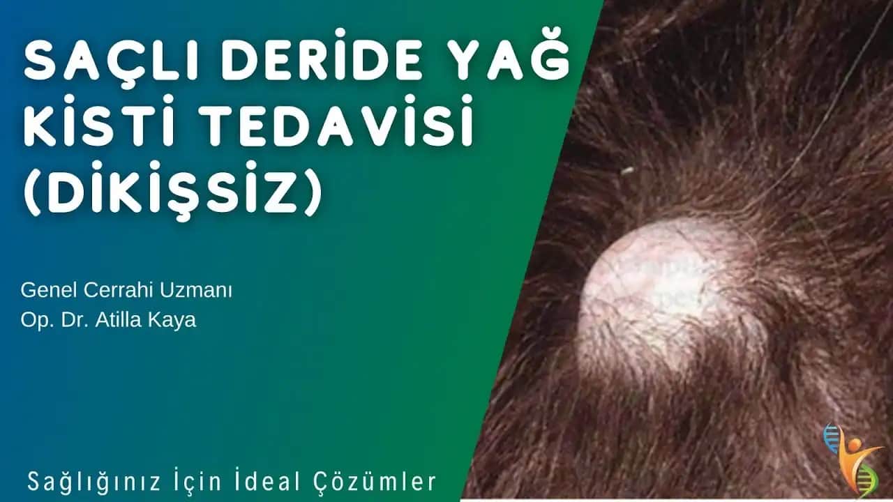 Saç Derisinde Yağ Bezi Nedir, Neden Oluşur ve En Uygun Tedavi Yöntemleri Nelerdir?
