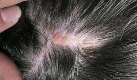 Saç Derisinde Yara Oluşumunun Nedenleri ve Etkili Tedavi Yöntemleri