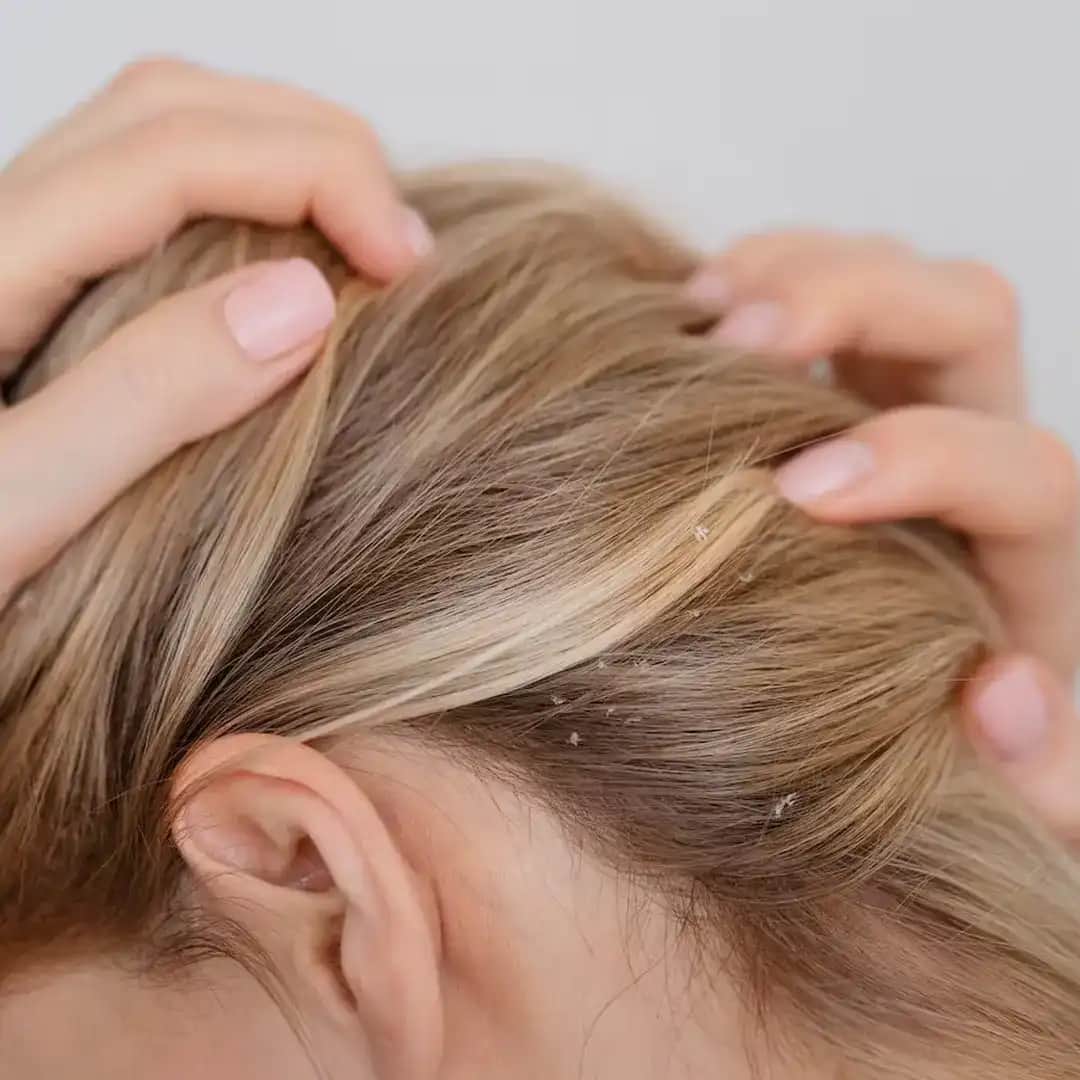 Saç Derisinin Kurumasını Önleme ve Sağlıklı Saçlar İçin Bakım Rehberi