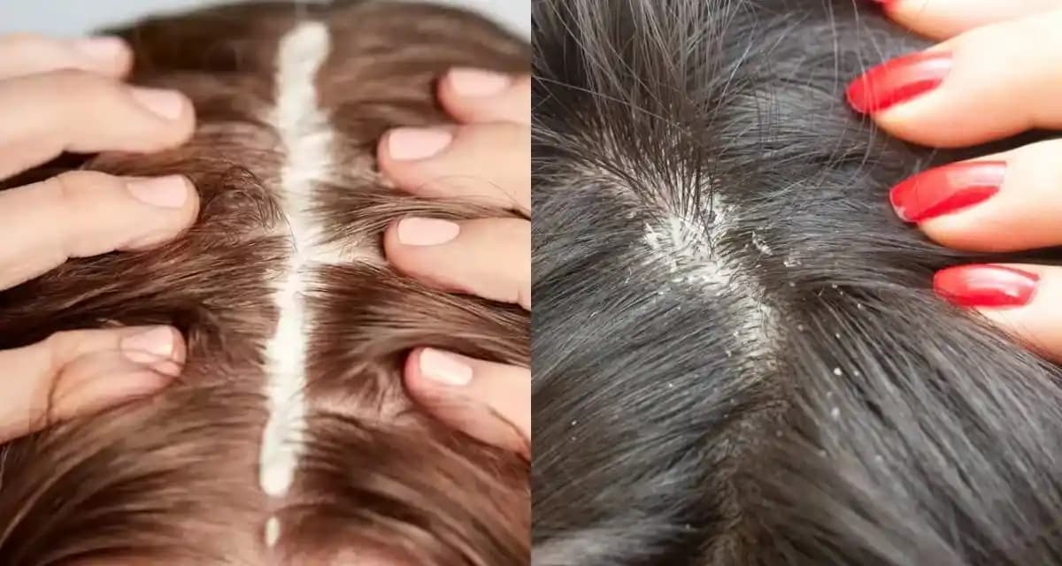 Saç Derisinin Soyulmasının Nedenleri ve Korunma Yöntemleri Hakkında Detaylı Bilgi