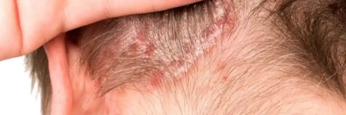 Saç Dibi Egzaması Nedenleri, Belirtileri ve Etkili Bakım Yöntemleri