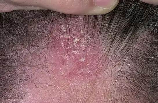 Saç Dibi Kaşıntısının Nedenleri ve Etkili Çözüm Yöntemleri ile Sağlıklı Saç Derisi