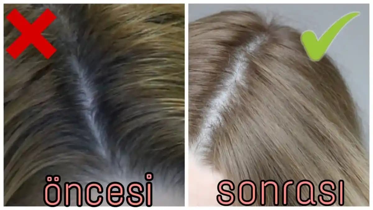 Saç Dibi Sivilceleri Nedenleri ve Etkili Bakım Yöntemleri Hakkında Bilgiler