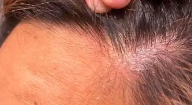 Saç Dibi Yarası Nedenleri Belirtileri ve Etkili Bakım Yöntemleri