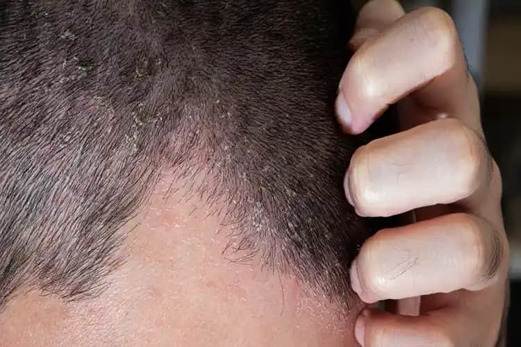 Saç Dipleri Yanmasının Nedenleri ve Gelişmiş Bakım Yöntemleri