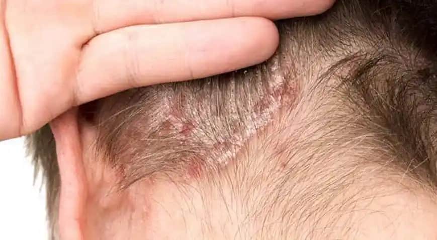 Saç Diplerindeki Kabuklanma Nedenleri, Belirtileri ve Etkili Çözüm Yolları