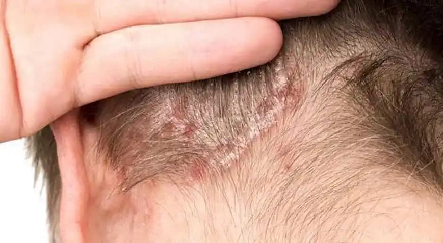 Saç Diplerindeki Kabuklanma Nedenleri, Belirtileri ve Etkili Çözüm Yolları