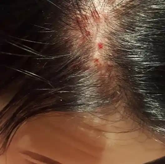 Saç Diplerindeki Sarı Kabuklanma Nedenleri ve Etkili Çözüm Yolları