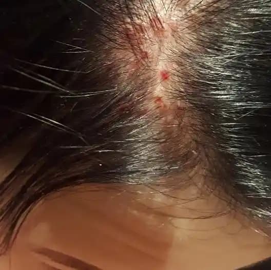 Saç Diplerindeki Sarı Kabuklanma Nedenleri ve Etkili Çözüm Yolları