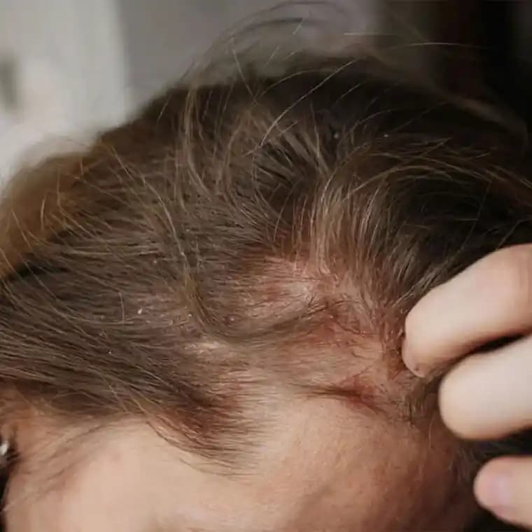 Saç Egzaması Nedir, Belirtileri ve Etkili Bakım Yöntemleri Hakkında Detaylı Bilgi