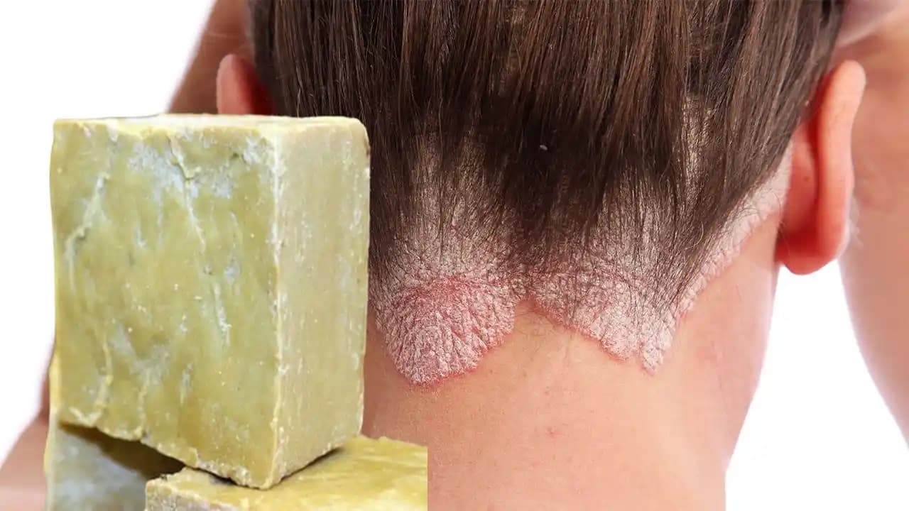 Saç Egzaması Nedir, Nedenleri ve Doğal Tedavi Yöntemleri Hakkında Kapsamlı Bilgi