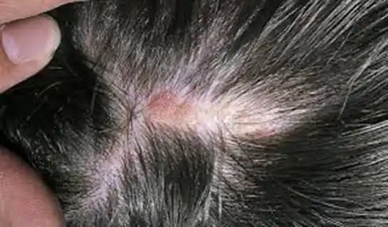 Saç İçinde Çıkan Yaralar: Nedenleri, Belirtileri ve Etkili Tedavi Yöntemleri