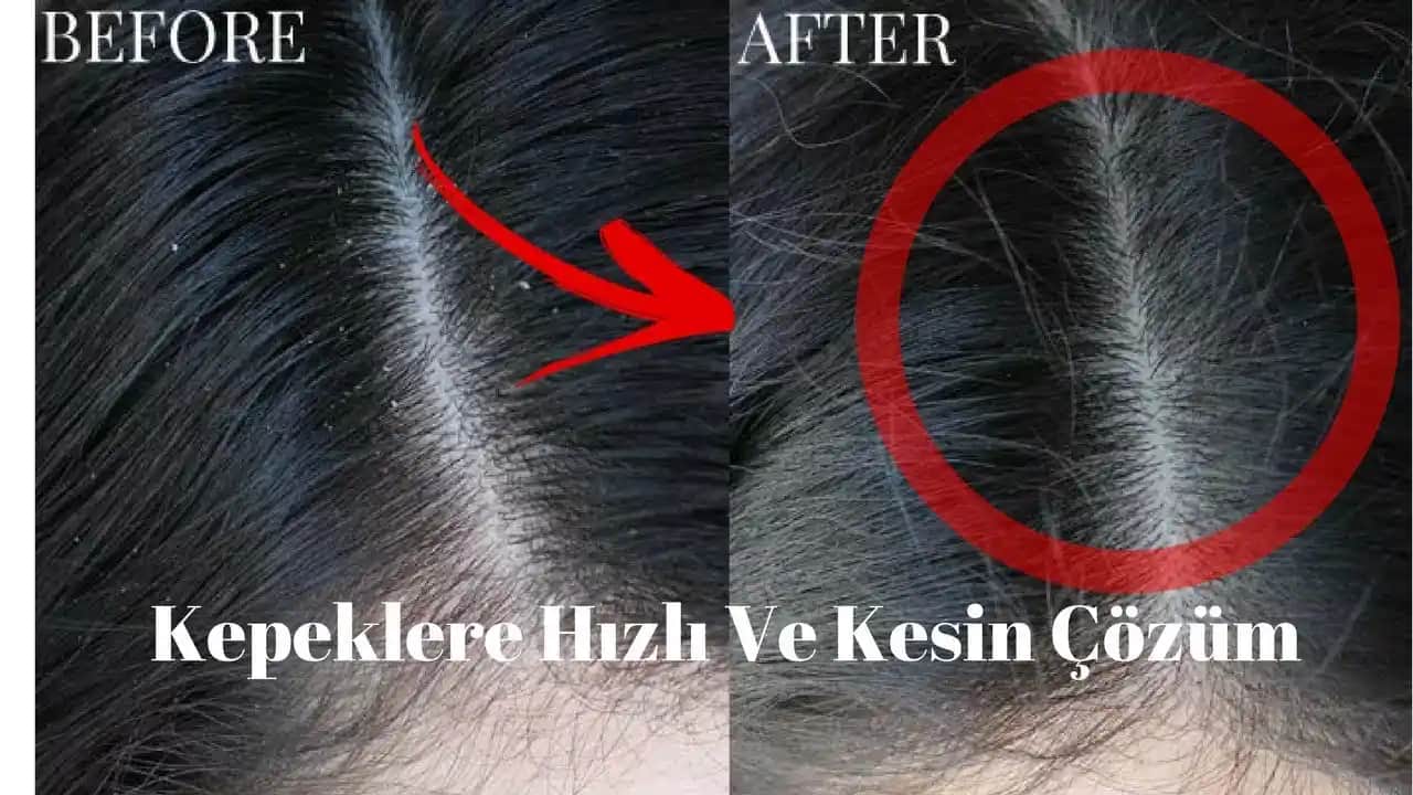 Saç Kepeğinden Kurtulma Yolları ve Sağlıklı Saçlar İçin İpuçları