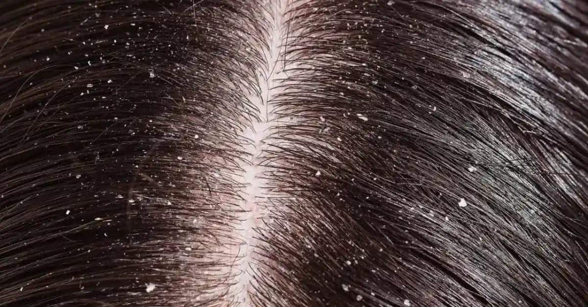 Saç Kepeklenmesinin Nedenleri ve Etkili Çözüm Yolları Hakkında Kapsamlı Bilgi
