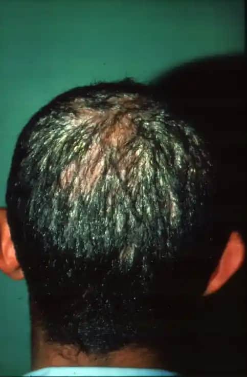 Saç Mantarı Nedir, Belirtileri, Nedenleri ve Kozmetik Yaklaşımlar