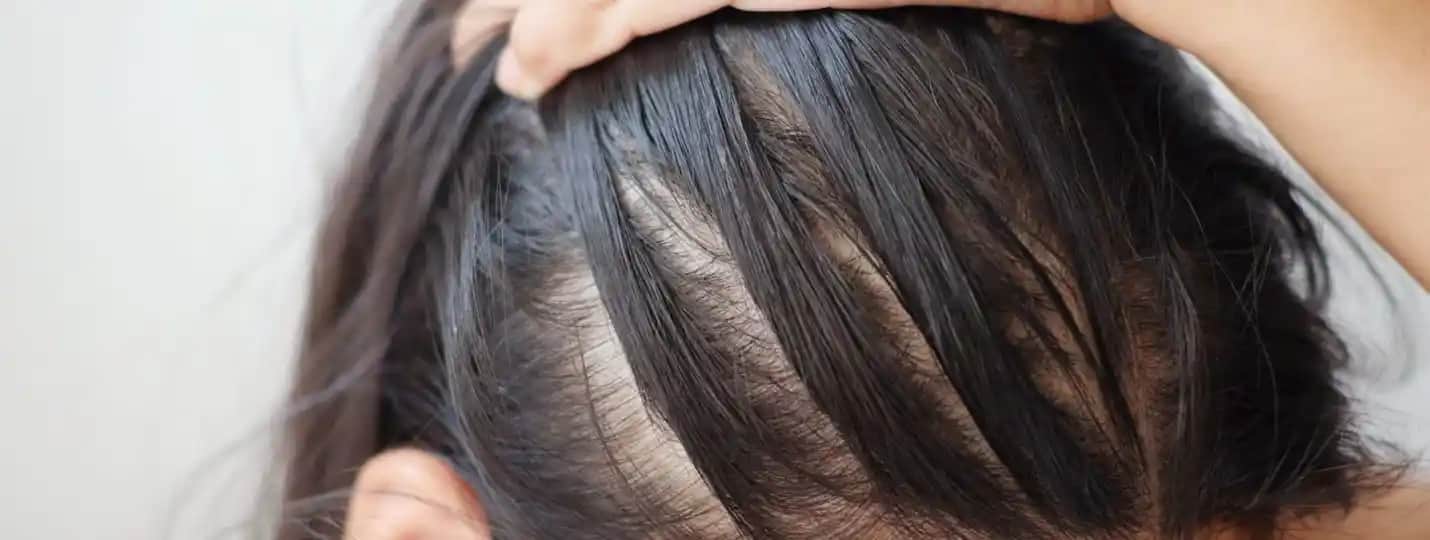 Saçın Aşırı Yağlanması Nedenleri ve Etkili Çözüm Yolları Hakkında Detaylı Bilgi