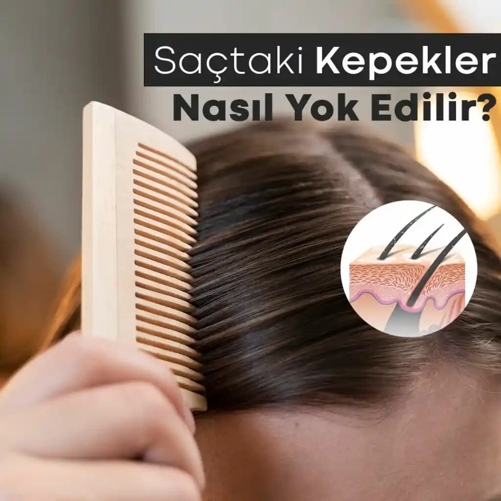 Saçlarda Kabuklanma Nedenleri, Belirtileri ve Etkili Çözüm Yolları Hakkında Detaylı Bilgi
