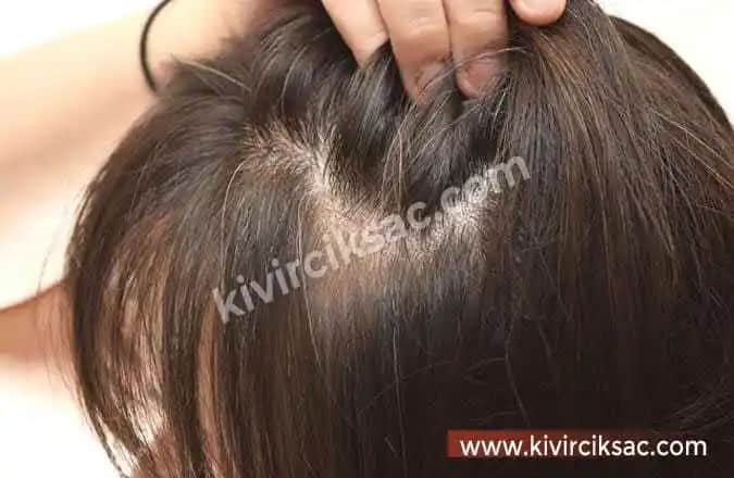 Saçlarda Kaşıntı ve Dökülmenin Nedenleri, Çözüm Yolları ve Uzun Vadeli Bakım Stratejileri