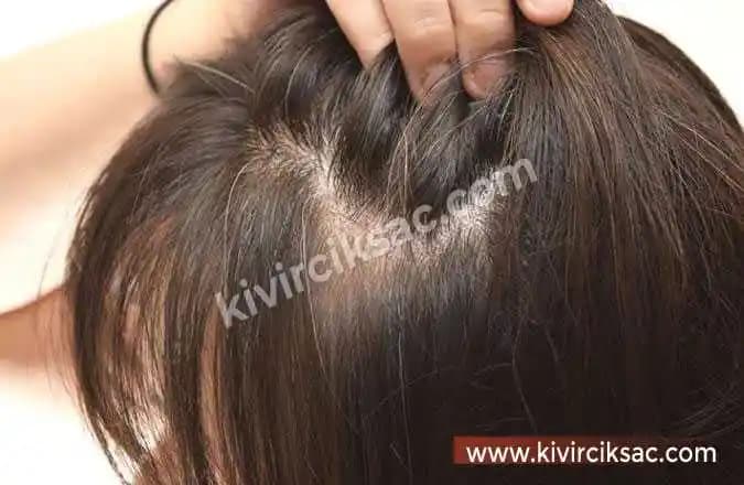 Saçlarda Kaşıntı ve Dökülmenin Nedenleri, Çözüm Yolları ve Uzun Vadeli Bakım Stratejileri