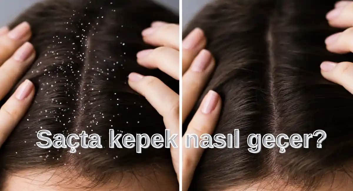 Saçlarda Kepek Nedenleri ve Etkili Çözüm Yöntemleri Hakkında Detaylı Bilgi
