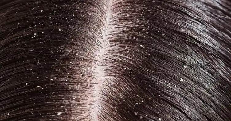 Saçta Aşırı Kepek Nedenleri ve Etkili Çözüm Yöntemleri Hakkında Bilgi