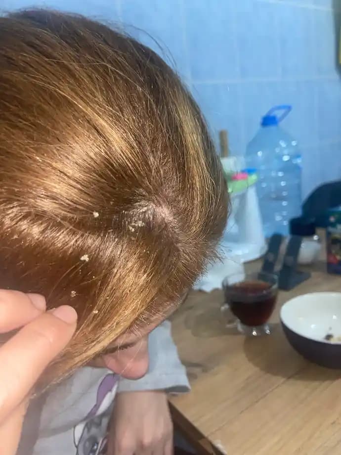 Saçta Beyaz Şeyler ve Dökülme Nedenleriyle Etkili Çözüm Yolları