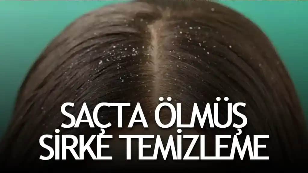 Saçta Bit Resmi Nedir ve Etkili Mücadele Yöntemleri Nelerdir