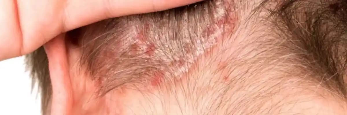 Saçta Egzama ve Mantar Problemleri: Belirtiler, Tanı ve Tedavi Yöntemleri