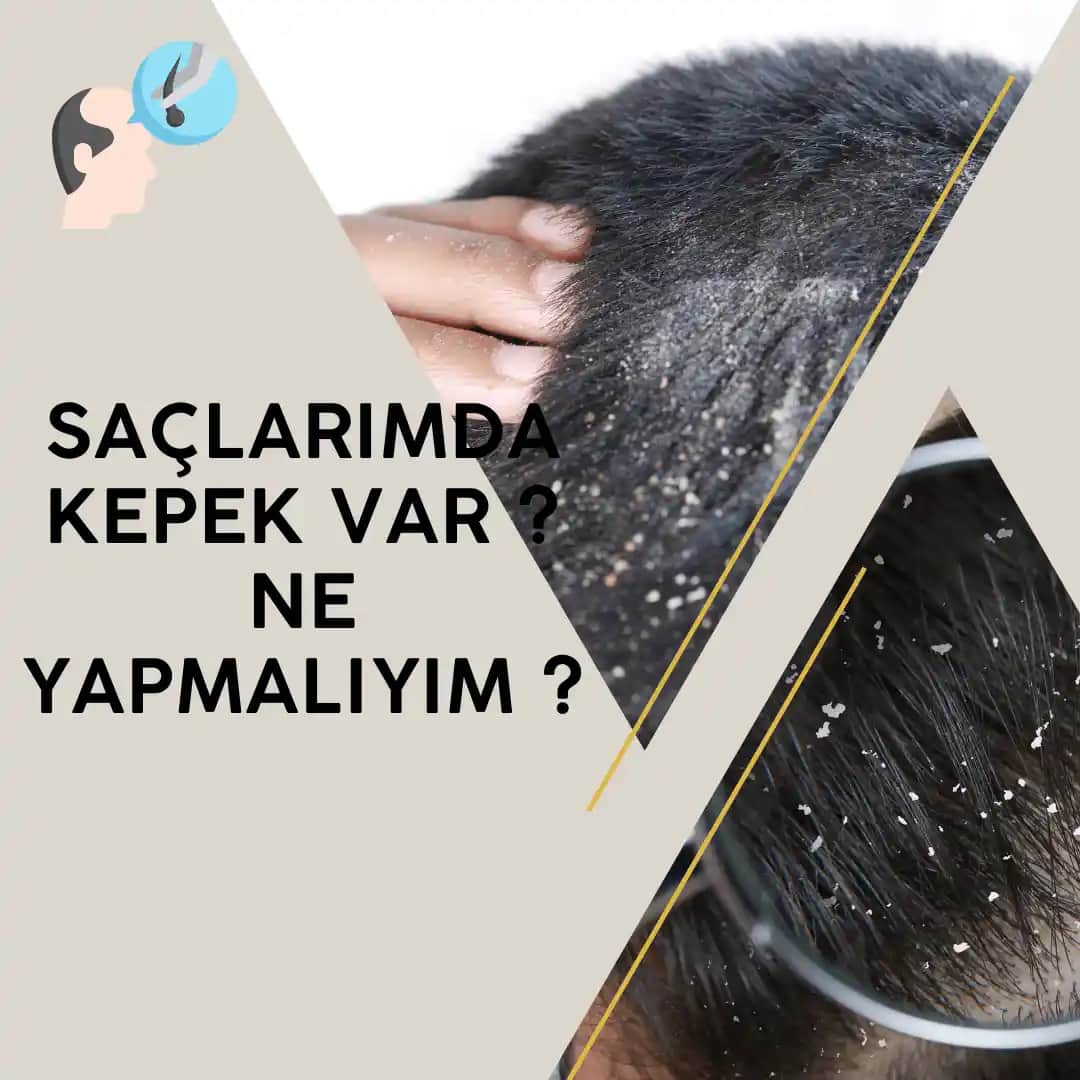 Saçta Kepek Sorunu Nedenleri ve Etkili Çözüm Yöntemleri Hakkında Detaylı Bilgi
