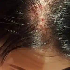 Saçta Sarı Kabuklanma Nedenleri, Tedavi Yöntemleri ve Koruyucu İpuçları