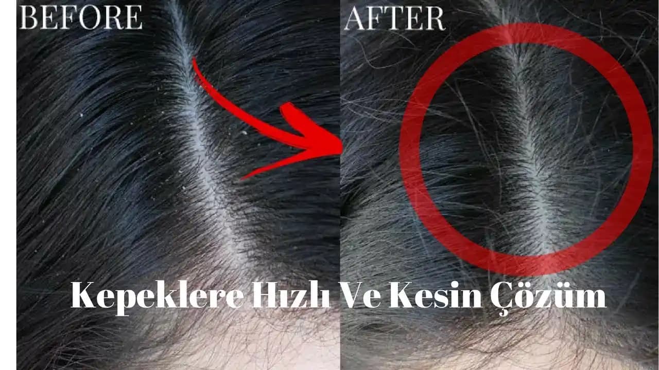 Saçtaki Kepekten Nasıl Kurtulunur: Doğru ve Etkili Yöntemler ve Tavsiyeler