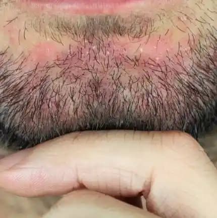 Sakal Bölgesinde Seboreik Dermatitle Mücadele: Doğru Bakım ve Kozmetik Yaklaşımlar