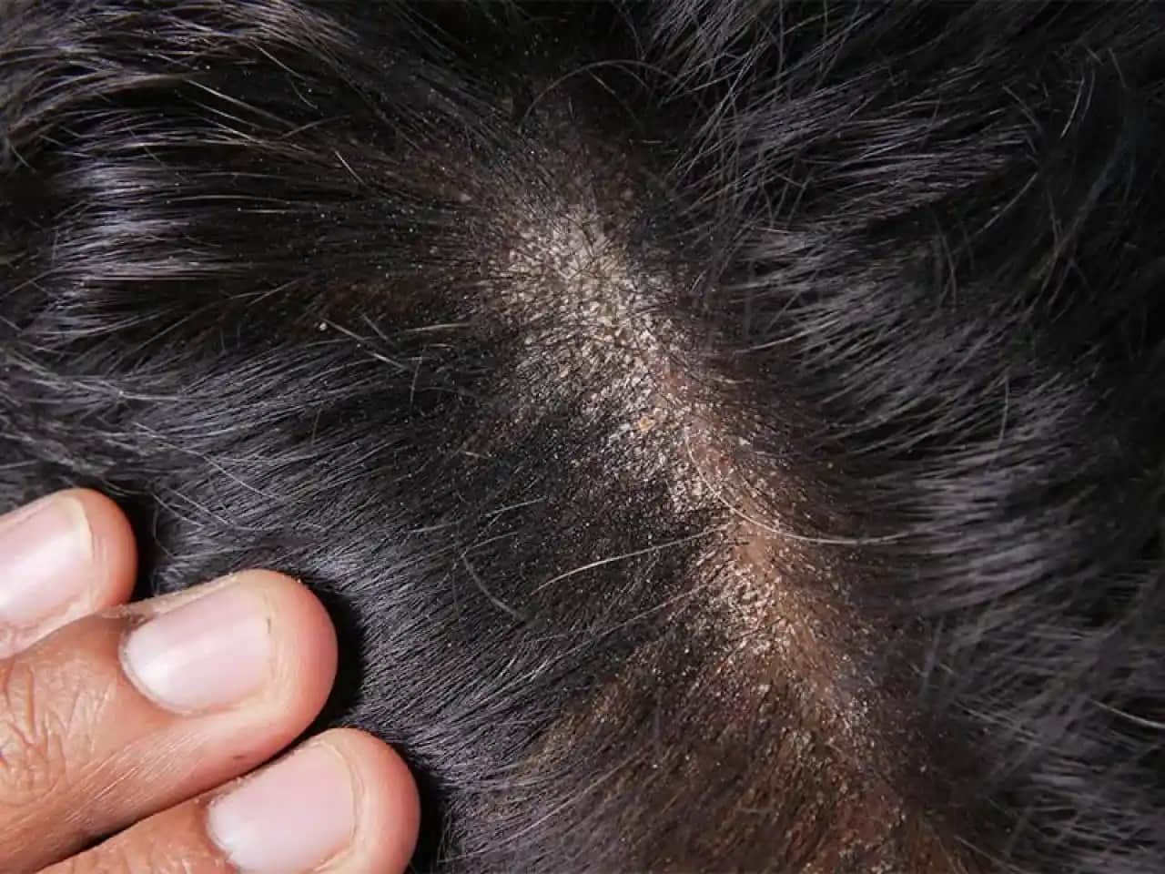 Sakal Kepeğine Karşı Etkili Çözüm Yöntemleri ve Bakım İpuçları