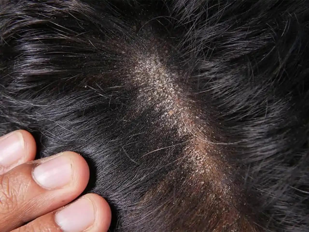 Sakal Kepeğine Karşı Etkili Çözüm Yöntemleri ve Bakım İpuçları