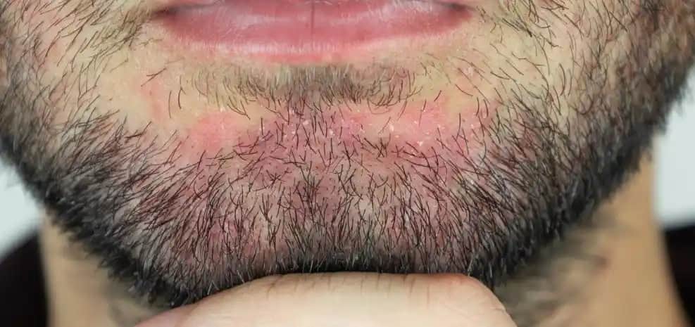 Sakal Kepeklenmesinin Nedenleri ve Etkili Çözüm Yöntemleri