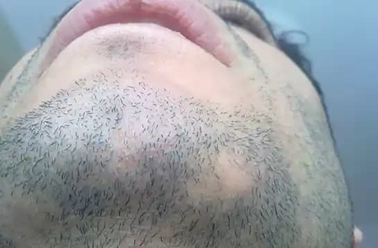 Sakal Kıran Nedir Belirtileri, Nedenleri ve Etkili Tedavi Yöntemleri Hakkında Kapsamlı Bilgi