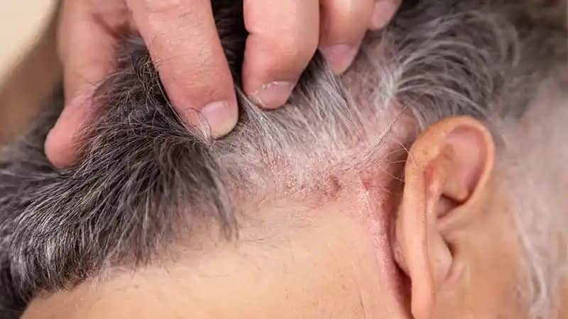 Seboreik Dermatitin Saç Dökülmesine Etkisi ve Doğru Tedavi Yöntemleri