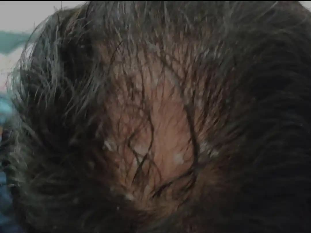 Seboreik Dermatitin Saç Dökülmesine Etkisi ve Saçların Yeniden Çıkması İpuçları