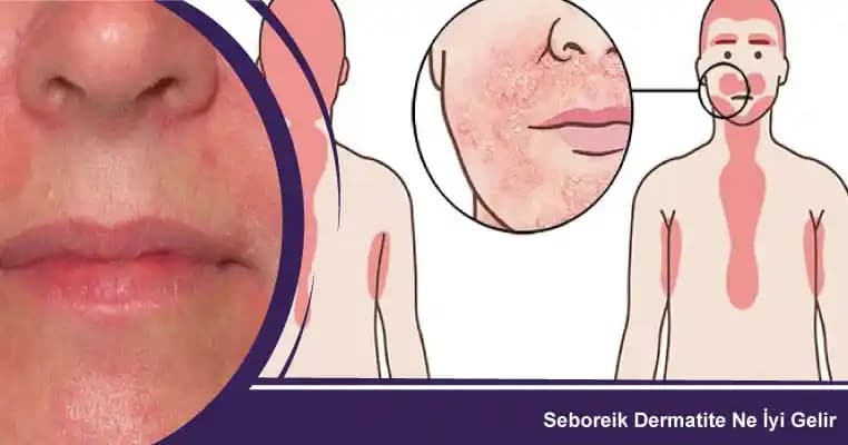 Seboreik Dermatitle Mücadelede Kozmetik ve Doğal Çözüm Yöntemleri
