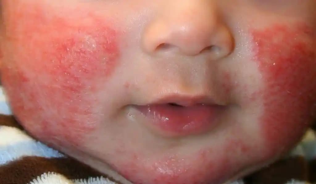 Seboreik Dermatitte Beslenme: Cilt Sağlığını Destekleyen Güncel Yaklaşımlar ve Tavsiyeler